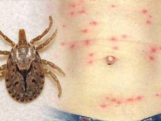 २२ जनामा स्क्रब टाइफसको सङ्क्रमण